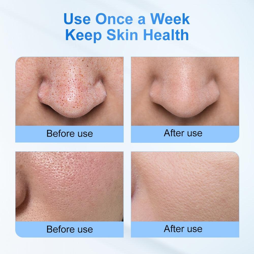 light chasing small bubble blackhead device